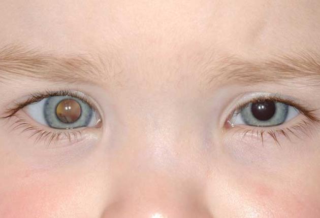 Resultado de imagen para retinoblastoma familiar